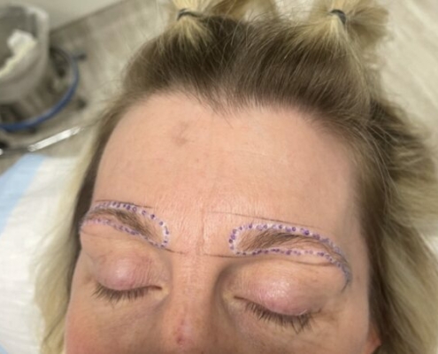 eyebrow transplant - Hair 4 Life - Dr. Kelemen