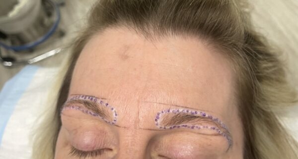 eyebrow transplant - Hair 4 Life - Dr. Kelemen