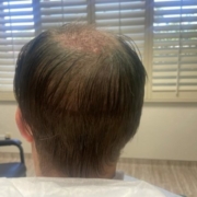 FUT Strip hair transplant - Hair 4 Life - Dr. Kelemen