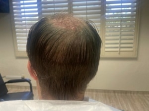 FUT Strip hair transplant - Hair 4 Life - Dr. Kelemen