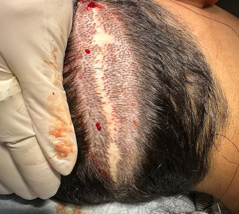 Scar Revision by Dr. Kelemen at Hair for Life in Scottsdale