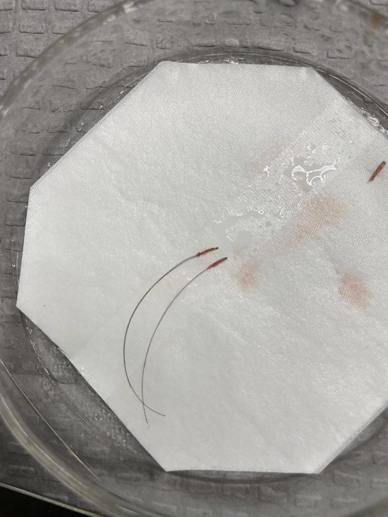 BHT - Body Hair Transplant 1