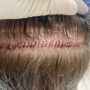 FUTStrip2-600x450 - Hair 4 Life Medical Hair 4 Life Medical - Dr. Kelemen