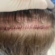 FUTStrip2-600x450 - Hair 4 Life Medical Hair 4 Life Medical - Dr. Kelemen