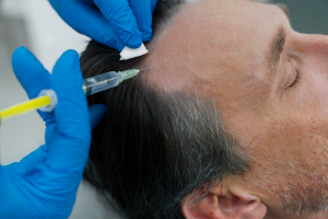 Scalp Injections and Alopecia