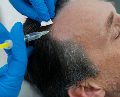 Scalp Injections and Alopecia