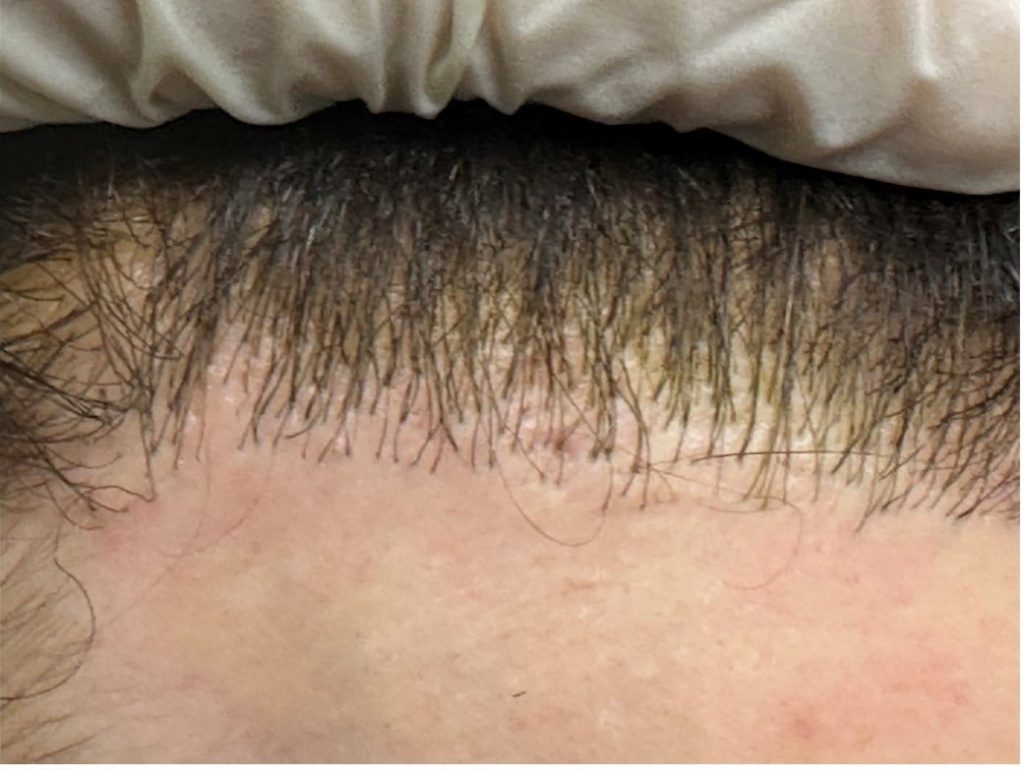 corrective hair transplant surgery