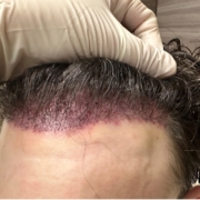 corrective hair transplant surgery