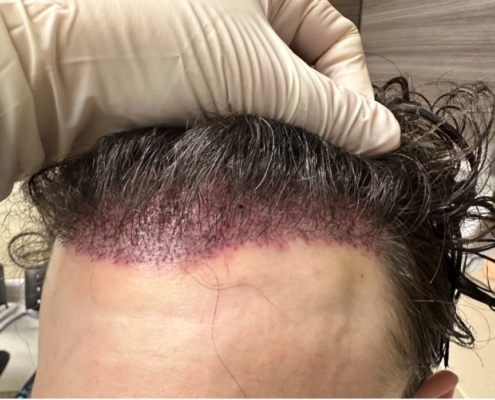 corrective hair transplant surgery