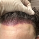 corrective hair transplant surgery