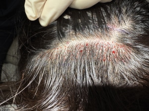 Eyebrow hair transplant harvest area