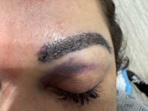Eyebrow hair transplant