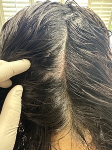 Harvest area for eyebrow hair transplant
