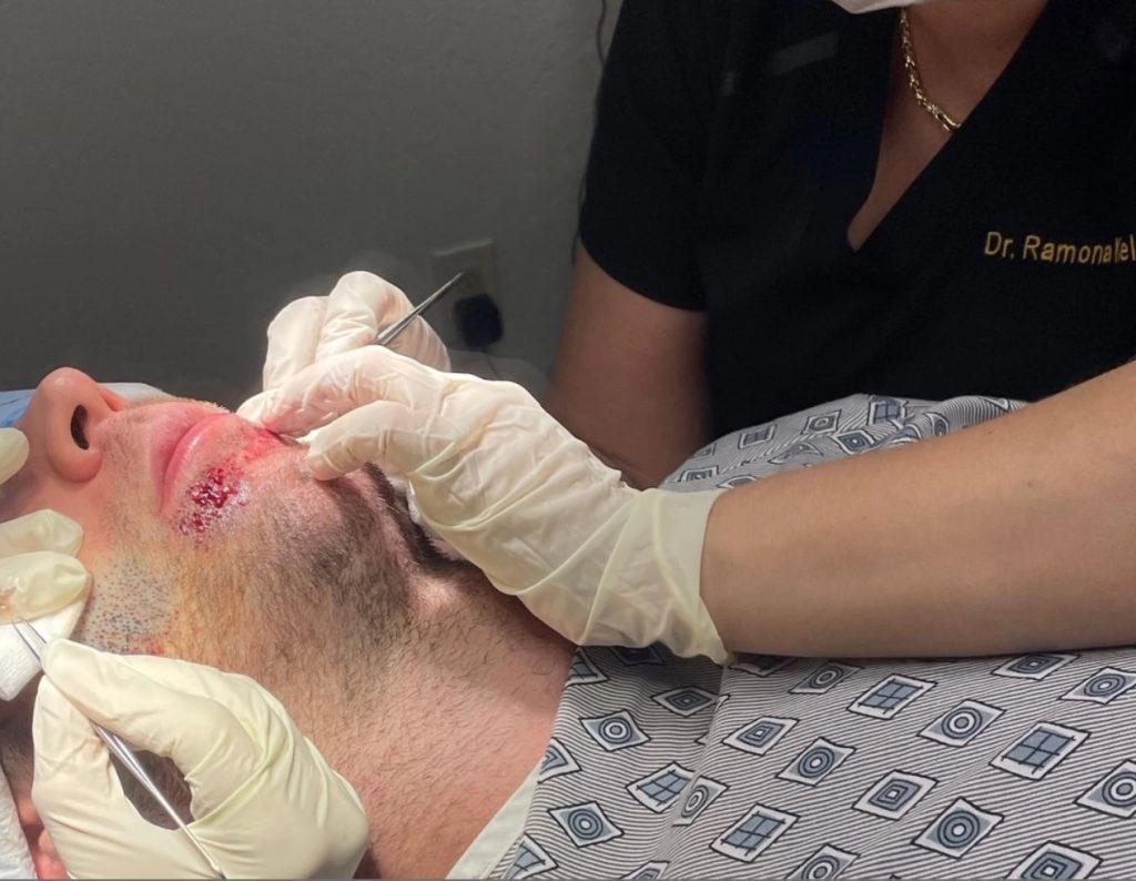 Beard hair transplant with Dr Kelemen
