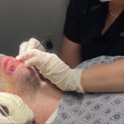 Beard Hair Transplant - Hair 4 Life Medical Beard hair transplant with Dr Kelemen