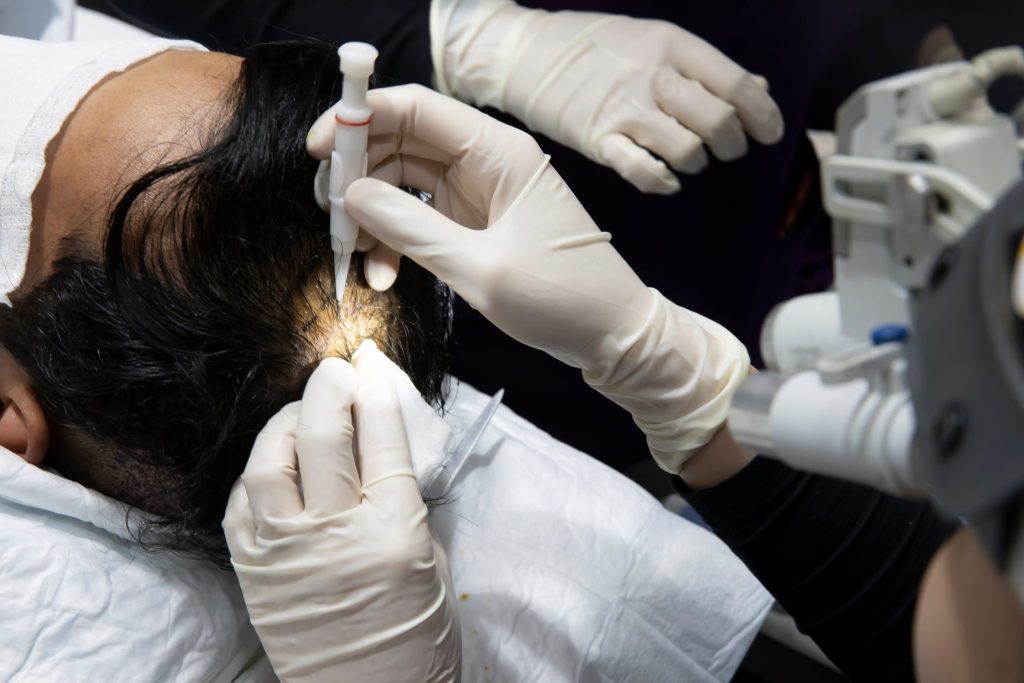 No Shave FUE Hair Transplant