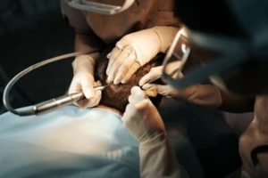 FUE Crown Hair Transplant