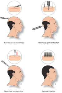 DHI process