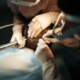 smartgraft hair transplant