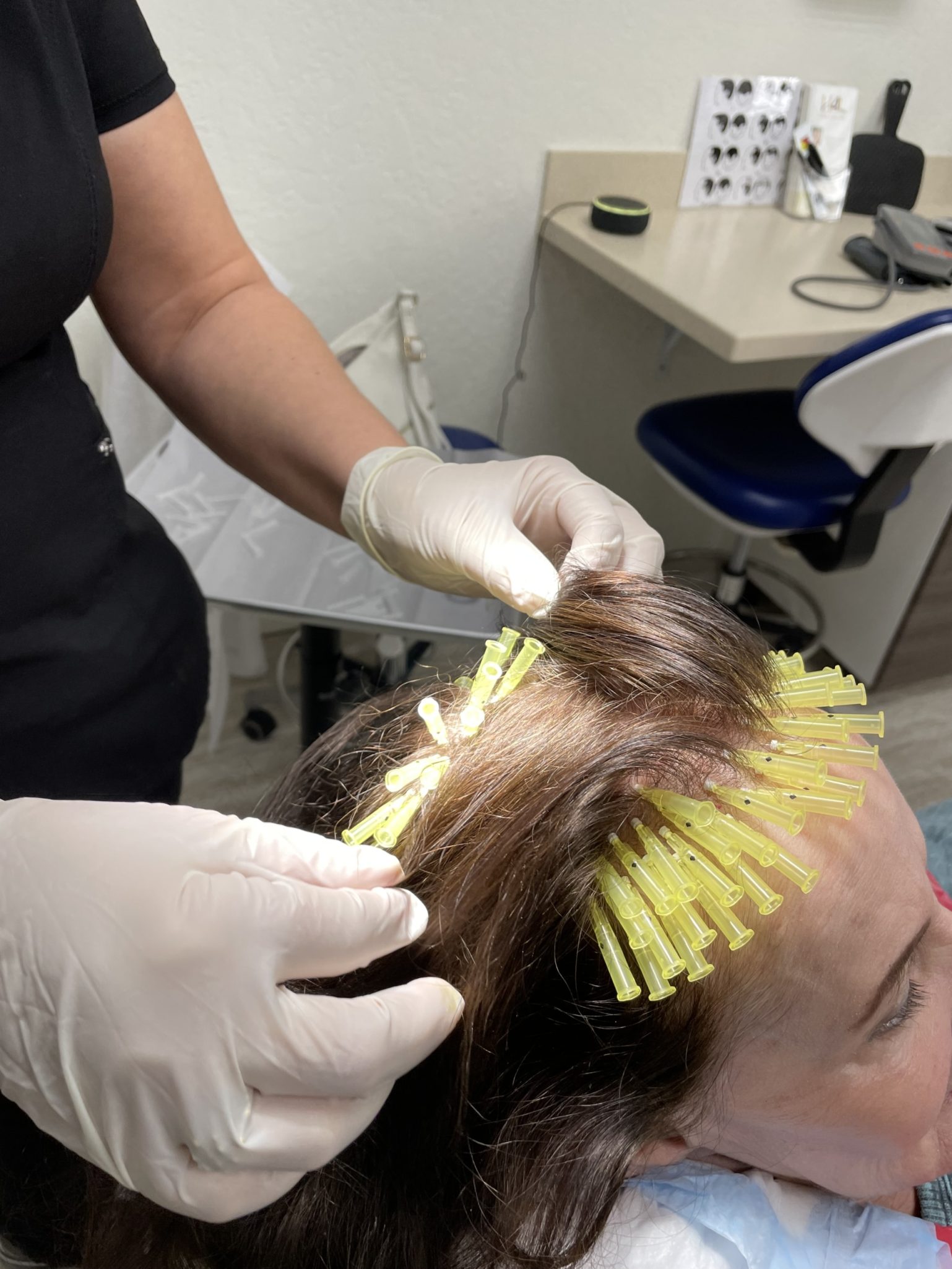PDO threads are used to improve blood flow to the scalp.