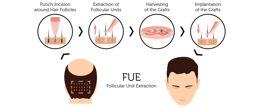FUE hair transplant diagram