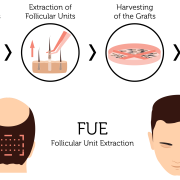 FUE hair transplant diagram