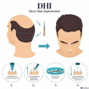 DHI hair transplant explanation