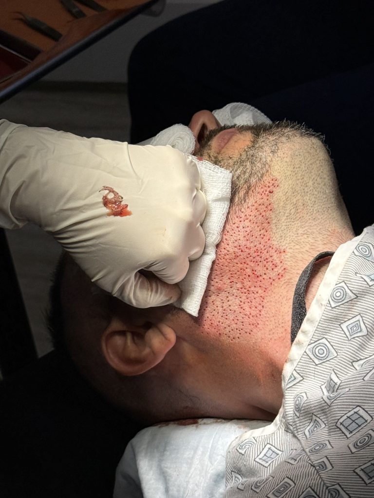 Beard to scalp Hybrid