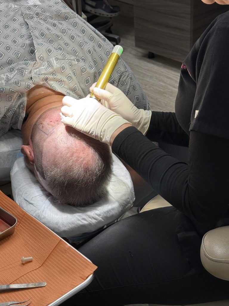 Hair-transplant with Dr Kelemen using the wireless WAW system