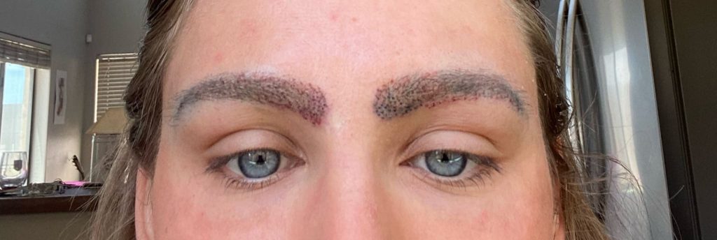 Eyebrow hair transplant FUE