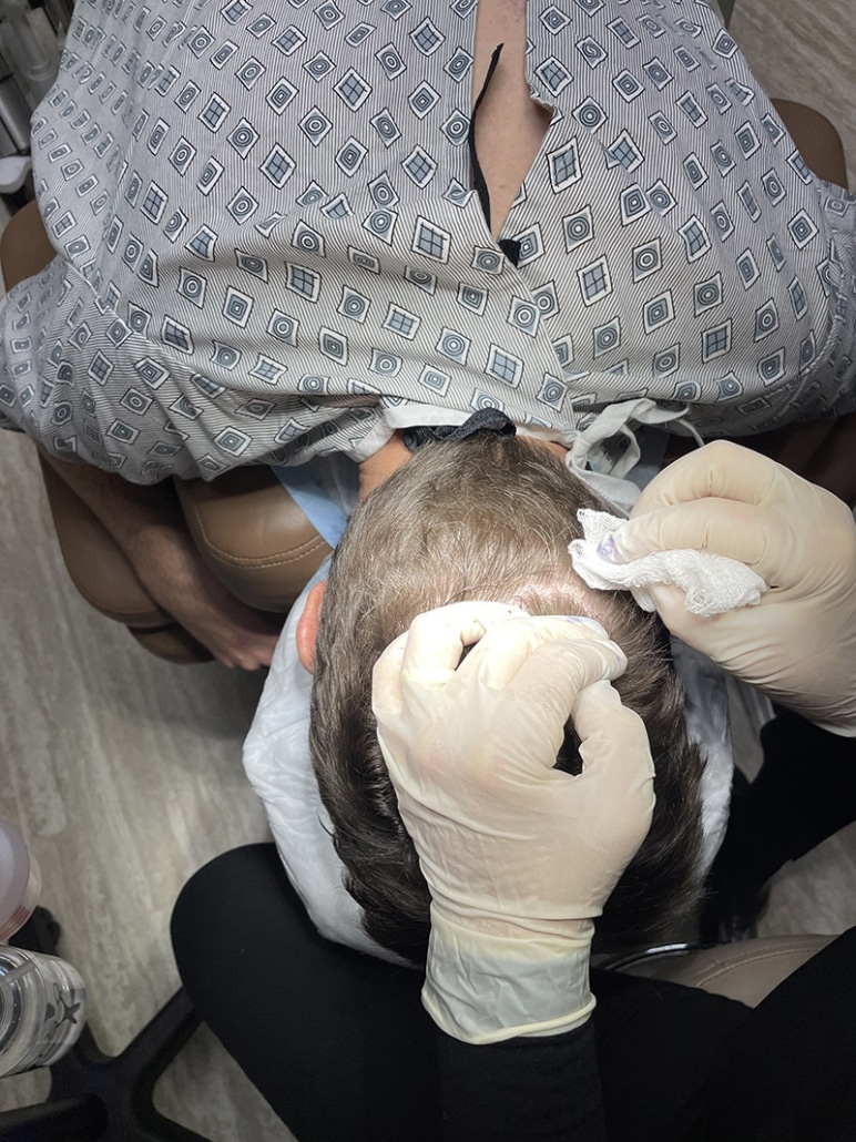 BHT-Body-Hair-Transplant-1-772x1030
