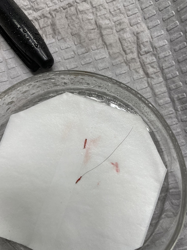 BHT-Body-Hair-Transplant-2-772x1030