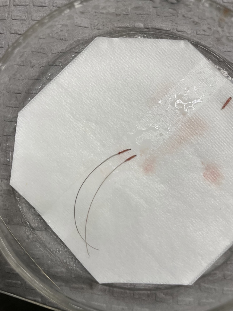 BHT-Body-Hair-Transplant-3-772x1030
