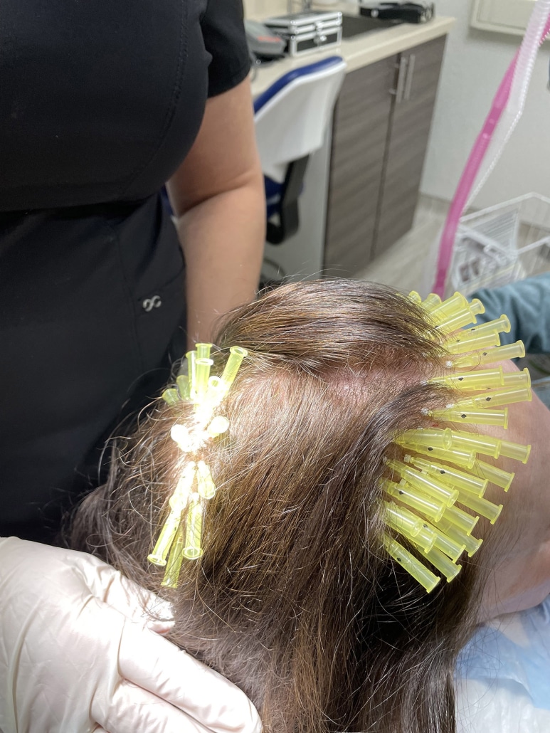PDO-Threads-Hair-Loss-Treatment-2-1-773x1030
