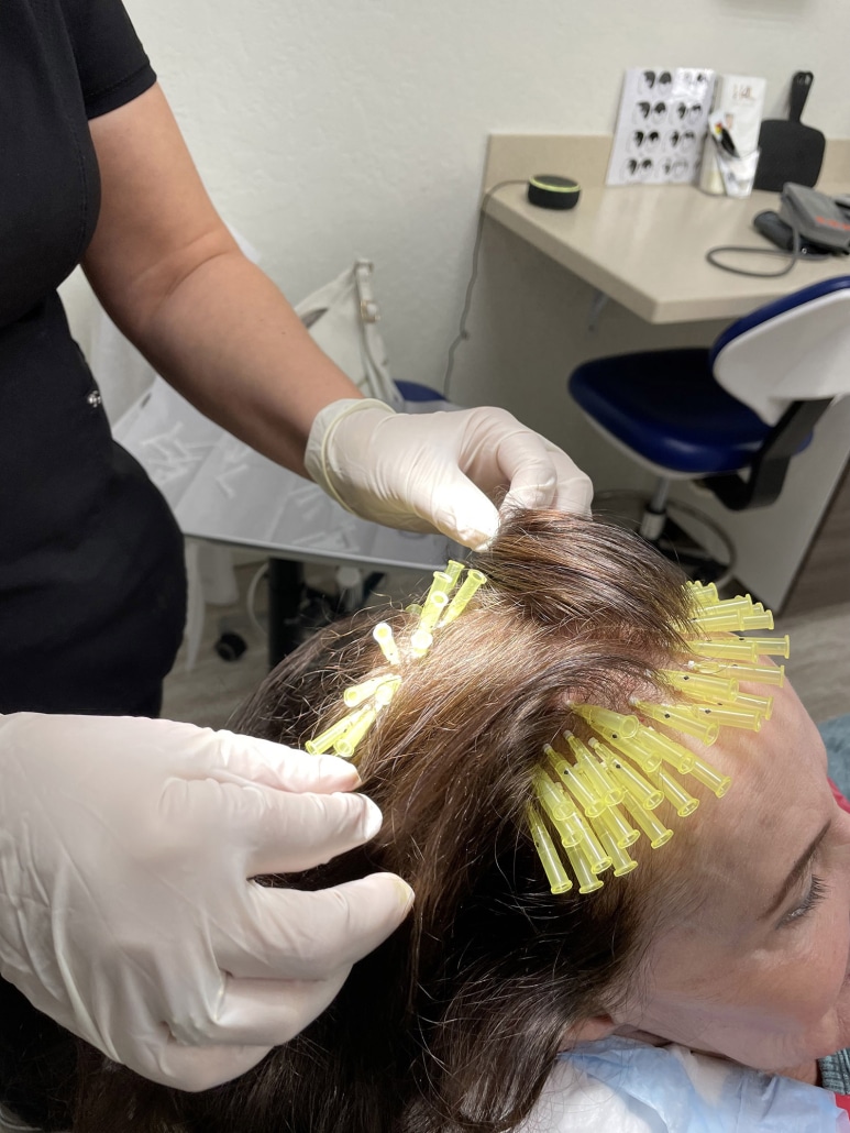 PDO-Threads-Hair-Loss-Treatment-3-773x1030