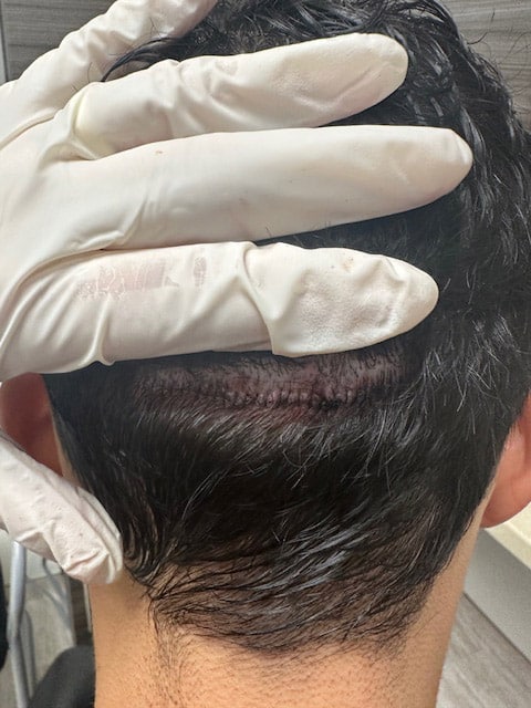 Scar-Revision-by-Dr.-Kelemen-at-Hair-for-Life-in-Scottsdale-2