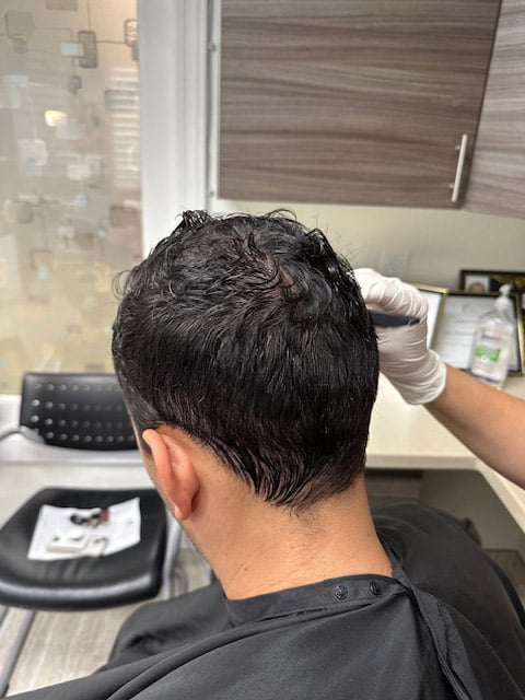 Scar-Revision-by-Dr.-Kelemen-at-Hair-for-Life-in-Scottsdale-3