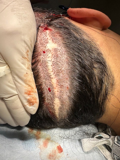 Scar-Revision-by-Dr.-Kelemen-at-Hair-for-Life-in-Scottsdale
